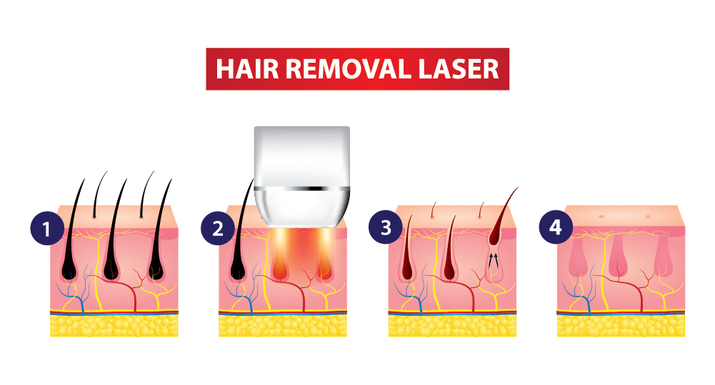 How does laser clearance hair removal work