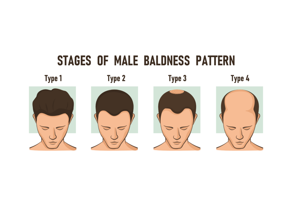 7 Stages of Male Pattern Baldness  Homeopathy Treatment  Dr Batras