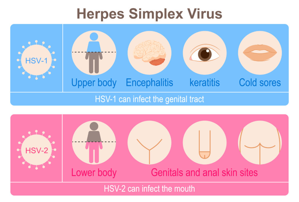 cold sores hsv 2