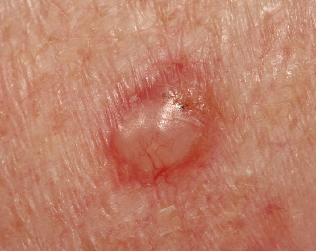 Basal Cell Carcinoma Katu Dermatology Clinic