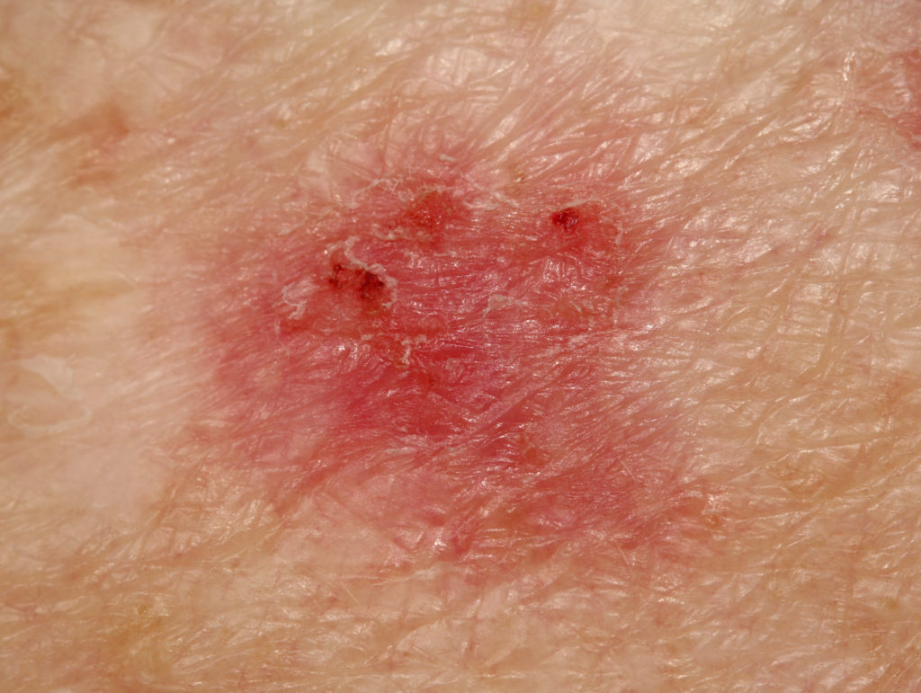 superficial basal cell carcinoma early stages