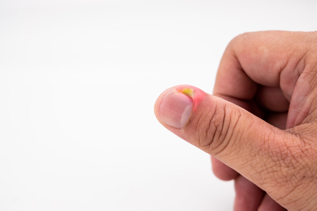 What you need to know about pseudomonas nail infections aka 