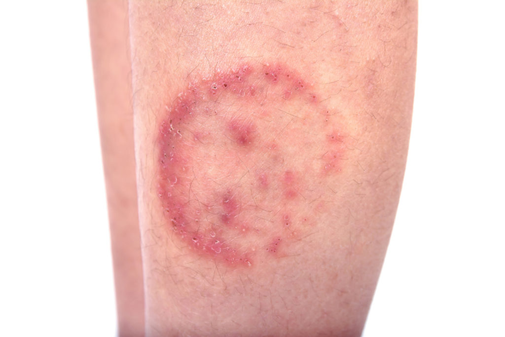 Ringworm Tinea Corporis Katu Dermatology Clinic