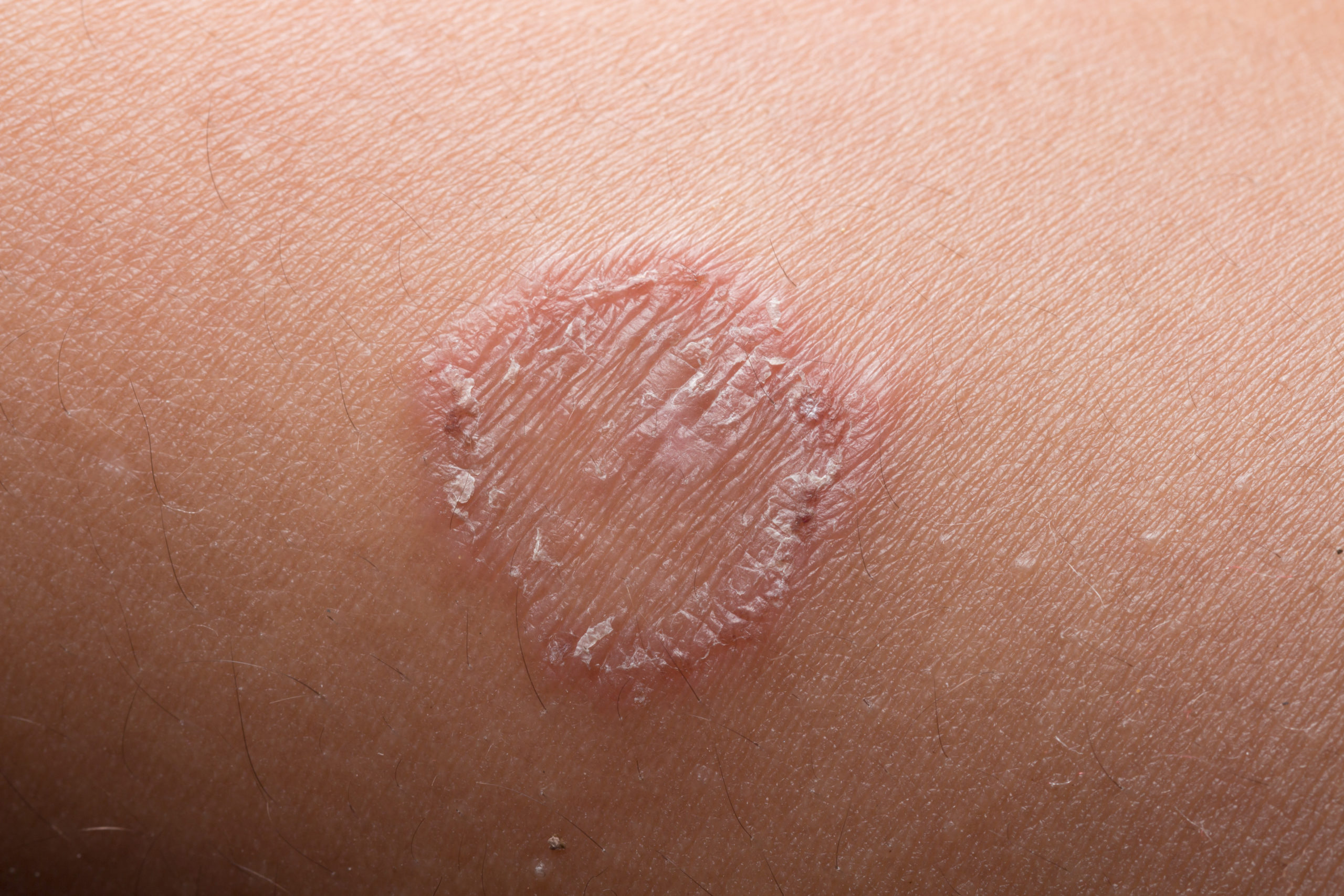 Ringworm (Tinea Corporis) - Katu Dermatology Clinic